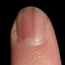 指甲有黑色條紋 (縱向黑甲症)，小心可能是皮膚癌 (惡性黑色素瘤)！ | 高雄林政賢皮膚科診所