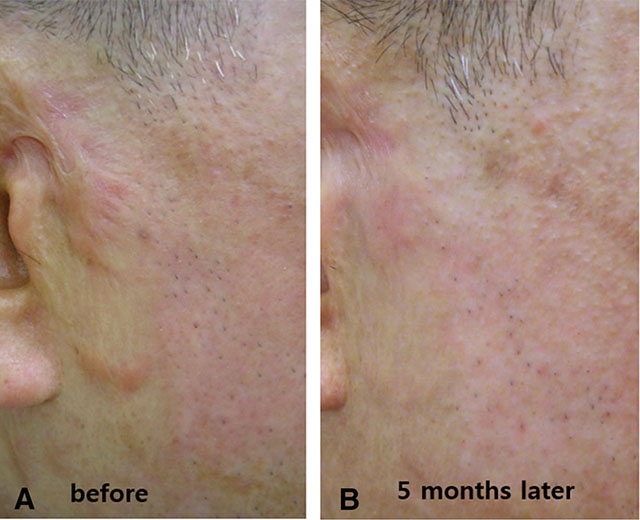 Ultrapulse 疤痕治療新利器up雷射 高雄林政賢皮膚科診所