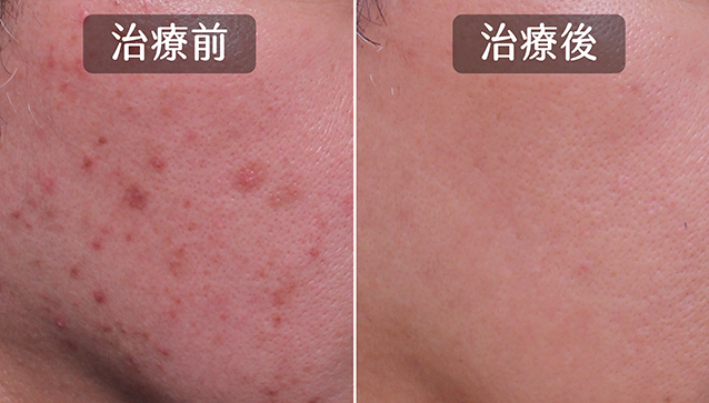 黑色痘疤消不掉 色素沉澱怎麼辦 一定要打雷射嗎 擦藥 保養品可以趕改善嗎