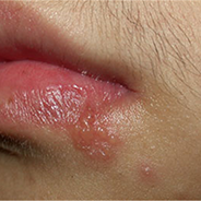 生殖器長皰疹，是性病嗎？身體虛累累，皰疹易復發！皮膚科醫師告訴你「長唇部皰疹會傳染嗎？」